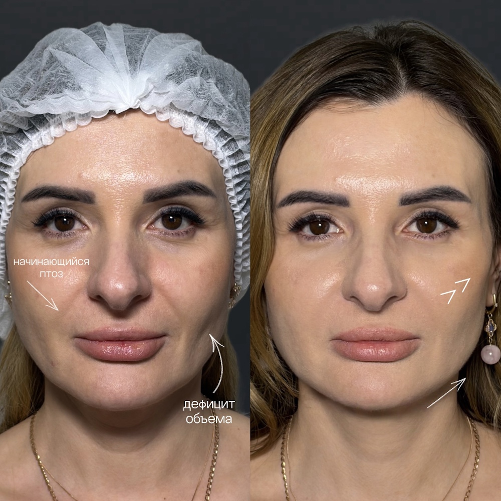 Деликатное уплотнение кожи без лишнего объёма 